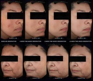 观察到的皮肤色调在持续使用美白精华液期间的变化情况