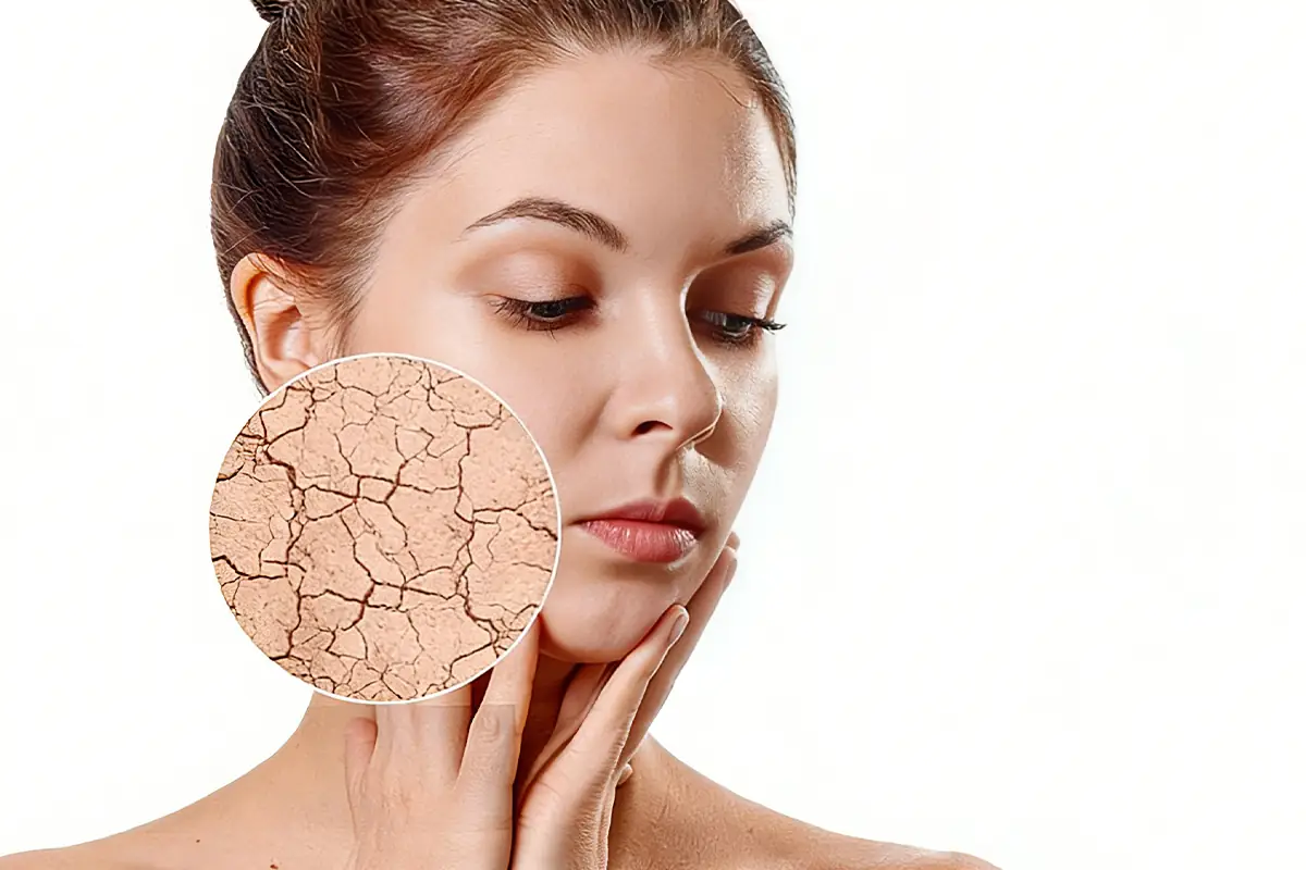 Damaged dry skin barrier with visible dryness cracks showing risk of whitening product irritation