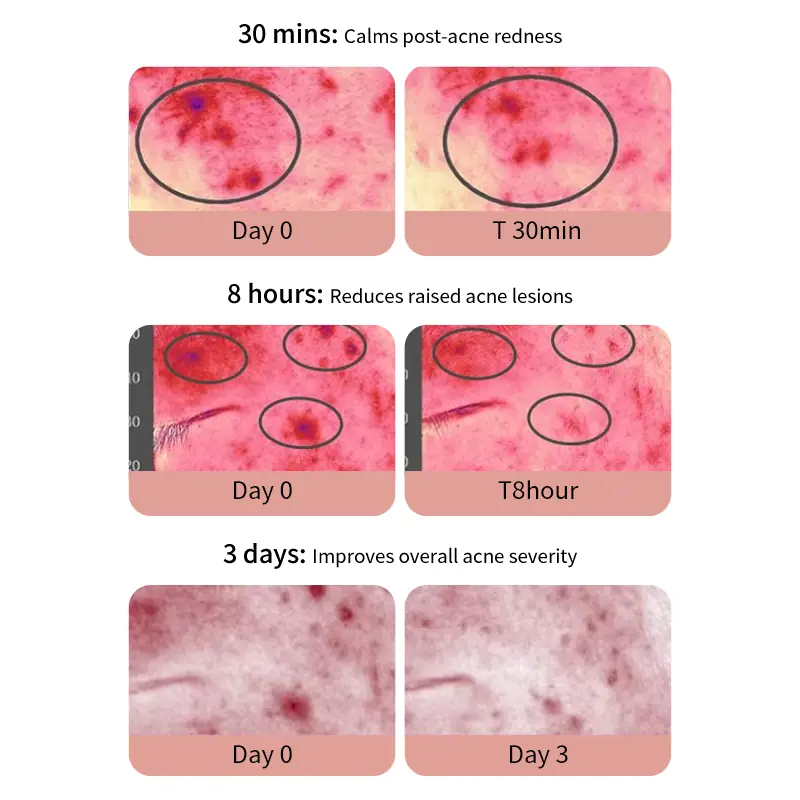 Instrument Tested Visible Acne Repair Results Instrument tested visible acne repair concept showing 30 minute redness relief 8 hour acne flattening and 3 day acne-prone skin improvement
